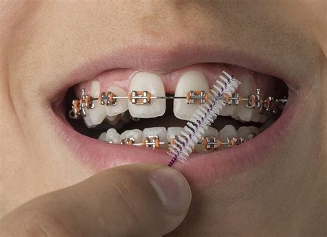 Traditional Braces Parsippany Nj Orthodontist Rauchberg Dental Group