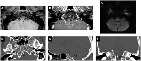 Frontiers CT Texture Analysis Of Vertebrobasilar Artery Calcification