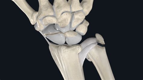 Distal Radioulnar Joint DRUJ Instability OrthoPedia