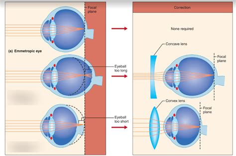 Figure: Eye (Near sighted- far sighted) Diagram | Quizlet