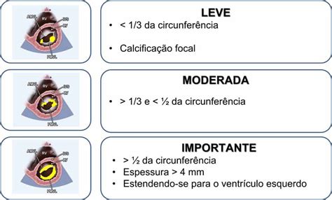 Calcificação do Anel Mitral como graduar Blog Ecope