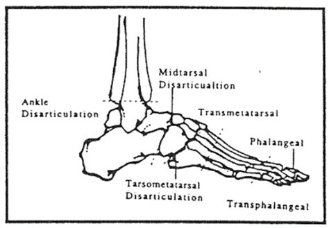 PTA249 Amputations Prostheses Flashcards Quizlet