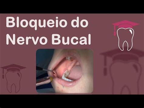 Bloqueio Do Nervo Bucal Youtube