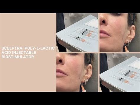 Sculptra Poly L Lactic Acid Injectable Biostimulator Youtube