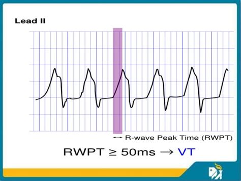 Ventricular Tachycardia Ppt