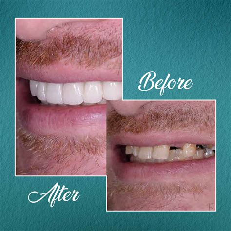 Full Mouth Dental Implants Turkey Package Deals Lerra Clinic Beauty