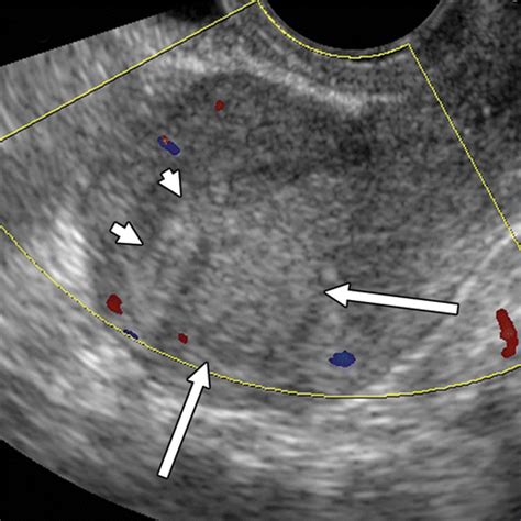 Gestational Trophoblastic Disease Clinical And Imaging Features Radiographics