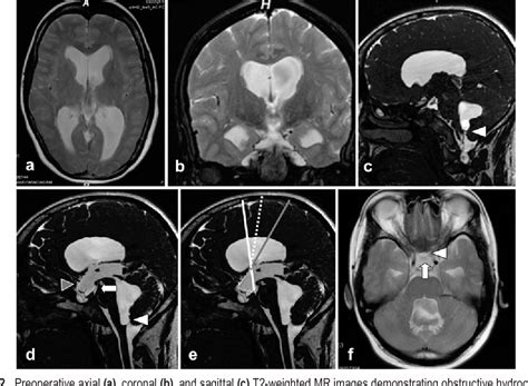 Figure 1 From Endoscopic Transventricular Third Ventriculostomy Through The Lamina Terminalis