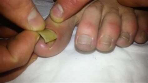 Removal of Dead toenail!!! - YouTube