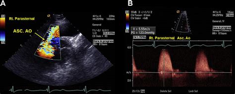 A Transthoracic Echocardiography 2d And Color Flow Doppler