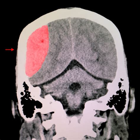 Tratamiento De Lesiones Cerebrales Traumáticas En Carolina Del Norte