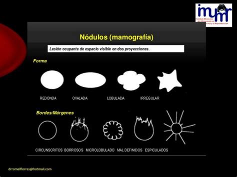 Lesiones Benignas Y Malignas De La Mama Por Ultrasonido DR ROMEL