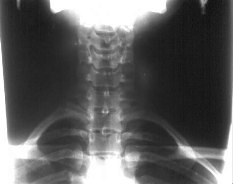 Cervical Rib Chest X Ray