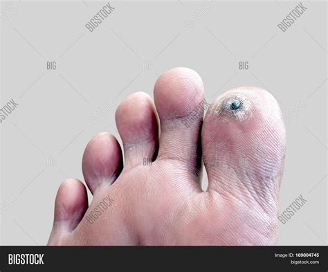 Callus On Toe Knuckle