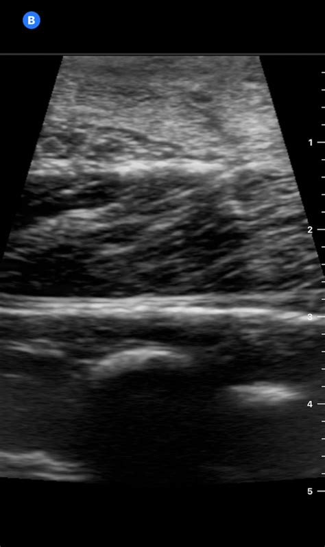 Comparing Nerve Block Models Meat Versus Vegetarian Options Em