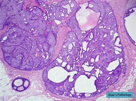 Flickriver Photoset Solid Papillary Carcinoma Of The Breast By Qiaos Pathology Art And