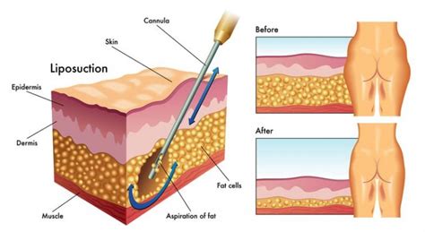 Vaser Hd Liposuktion T Rkei Kosten Verfahren Besteklinik