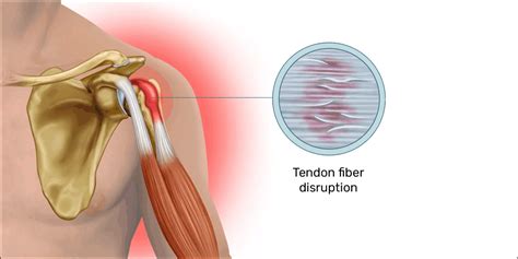 Tendonitis And Tenosynovitis Form Hand Therapy Atelier Yuwa Ciao Jp