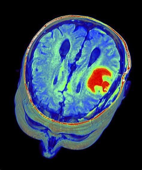 Mri scan, Brain tumor, Mri