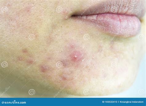 Skin Problem With Acne Diseases Close Up Woman Face With Whitehead