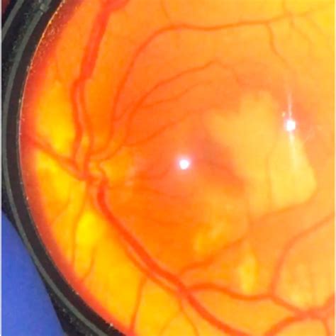 Left Eye Dilated Fundus Exam Photograph Taken At Bedside In The Icu On Download Scientific