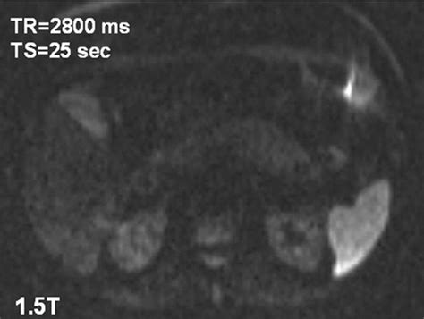 Characterization Of Genitourinary Lesions With Diffusion Weighted