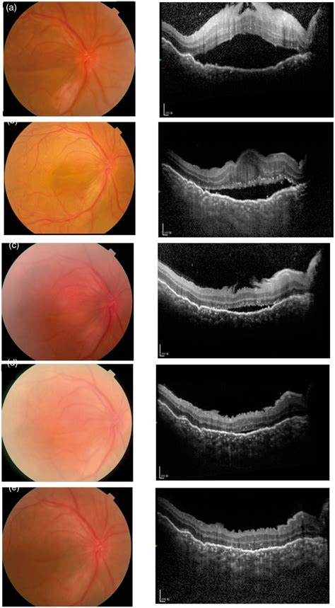 Serous Retinal Detachment Oct