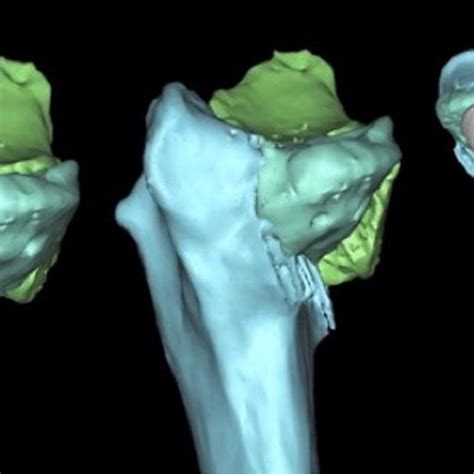 Virtual Reduction And Plating Of A Complex Intra Articular Distal