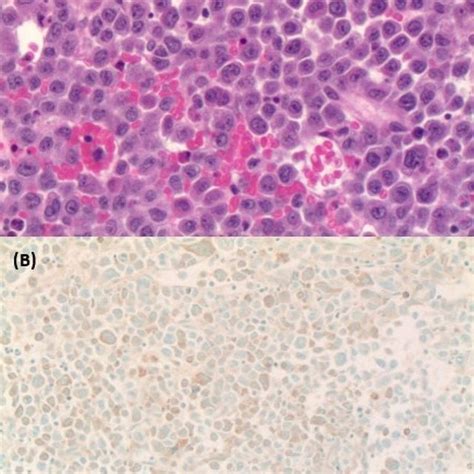 A Bone Marrow Biopsy Hematoxylin And Eosin Stain Showing Sheets Of