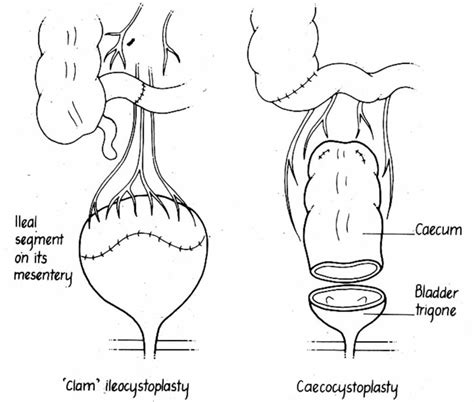 Bladder Augmentation Cystoplasty Indications Complications Recovery