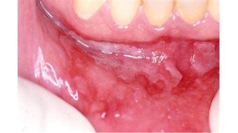 Penfigoide Das Membranas Mucosas Patologia Bucal