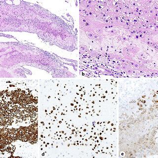 Histological Features And Immunohistochemical Staining Results Of The