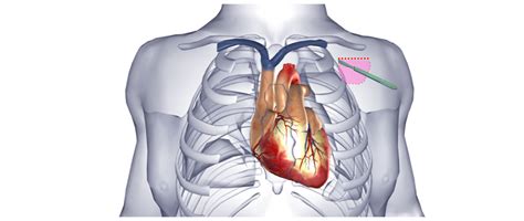 Cardiac Resynchronization Therapy Crt One Heart Cardiology