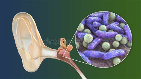 Otitis Media Inflammatory Disease Of The Middle Ear Stock Illustration