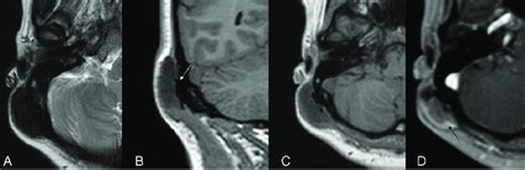 Case 1 MR Images With And Without Contrast Axial T2 A Coronal And