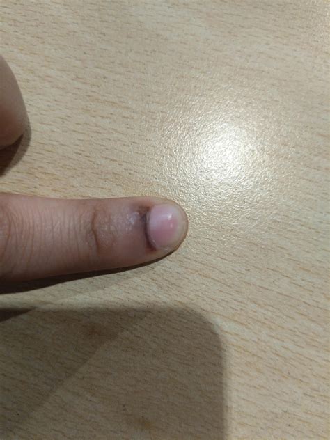 What happened to my finger. I was cooking and then before I knew it my