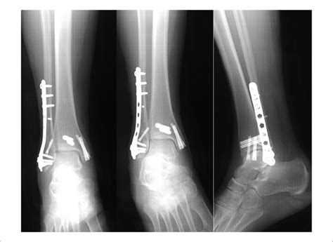 Anteroposterior Mortise And Lateral Radiograph At The Month