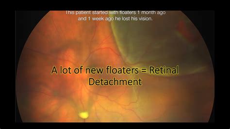 Vitrectomy For Floaters And Retinal Detachment I Patient Started With