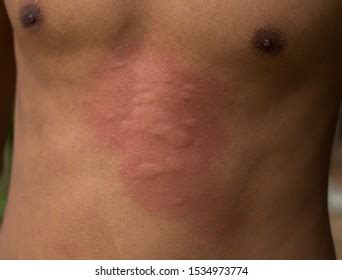 Human Skin Presenting Allergic Reaction Allergic Nh C S N