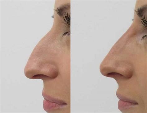 Hooked Nose Historically Better Known As Roman Nose Rhinoplasty Cost Pics Reviews Qanda