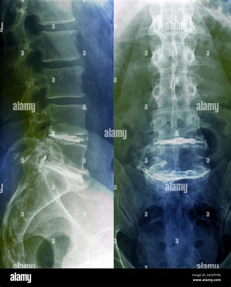 Sciatica Coloured X Rays Of The Lumbar Lower Back Spine Of A 48 Year