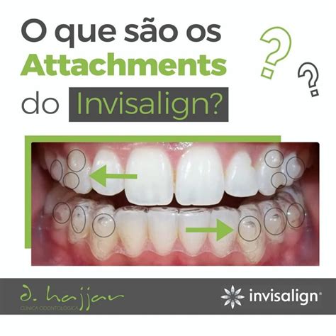 Como Funciona O Tratamento Invisalign 5 Vantagens