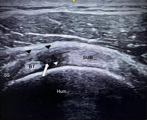 Ultrasound Guided Injection Through The Rotator Cuff Interval A Clinical Perspective Of One