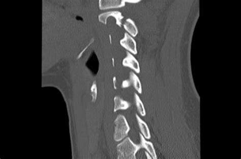 C Spine Injuries Ct Interpretation Core Em