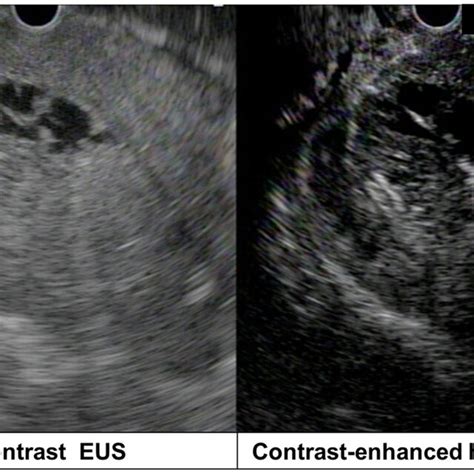 Contrast Enhanced Harmonic Endoscopic Ultrasonography Shows Mixed