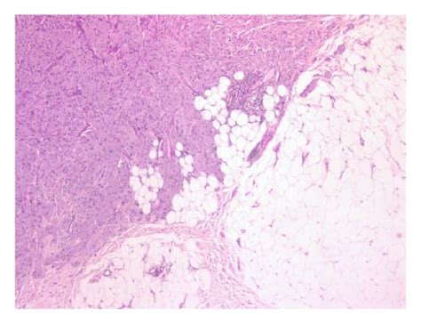 A Subcutaneous Mass Of Breast B Minimal Acanthosis And Epidermal