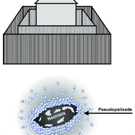 | Palisades and pseudopalisading cells. Palisades are defined as a ...