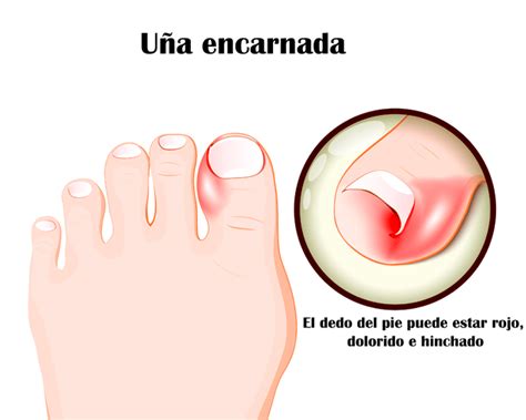 Uña encarnada Cínica de Podología Integral Pododerm