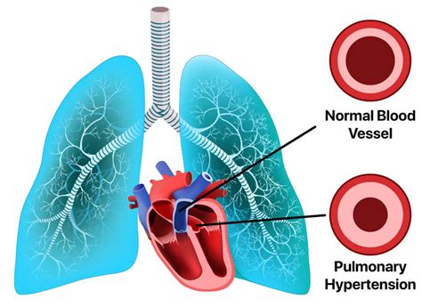 Xolair Side Effects | Cancer, Vasculitis & Other Risks