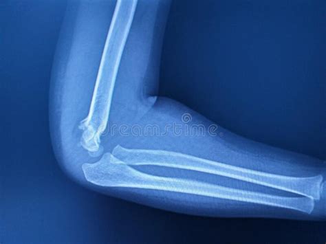 X Ray Image Of Humerus Fracture Stock Photo Image Of Fracture Joint